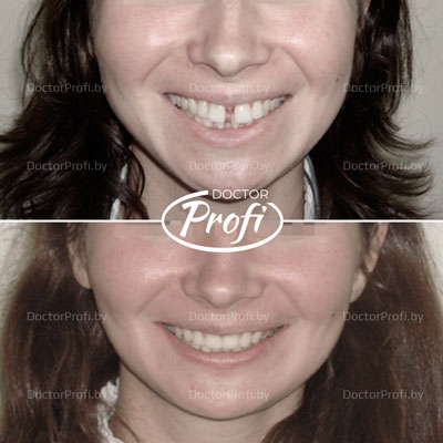 Устранение промежутка между зубами и чрезмерного наклона зубов