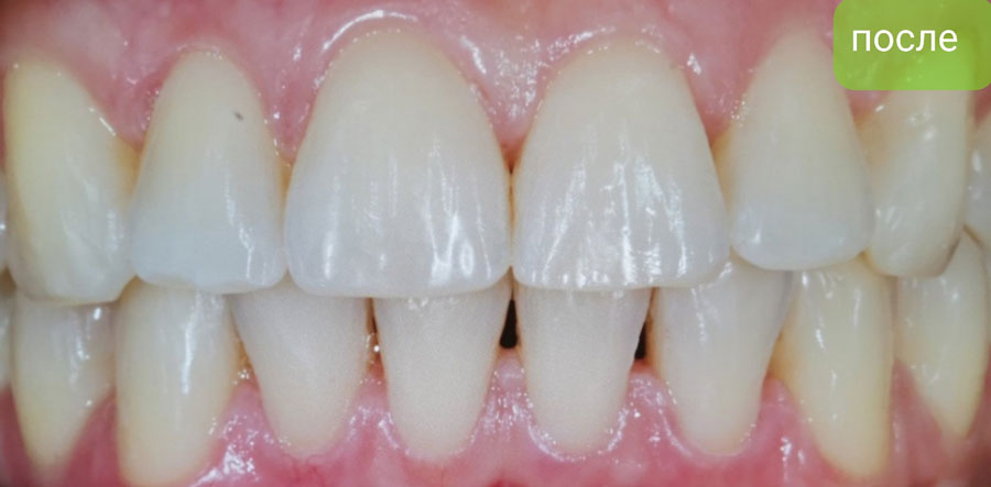 Исправление прикуса брекет-системой Damon Q