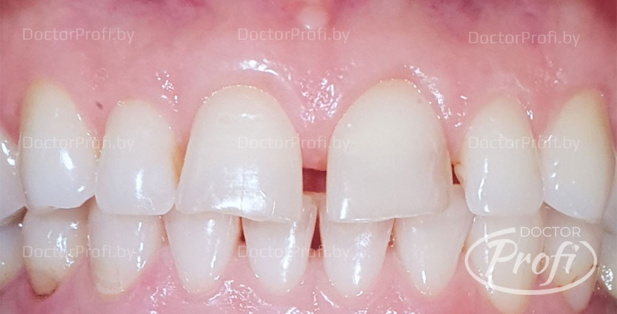 Устранение диастемы между передними зубами