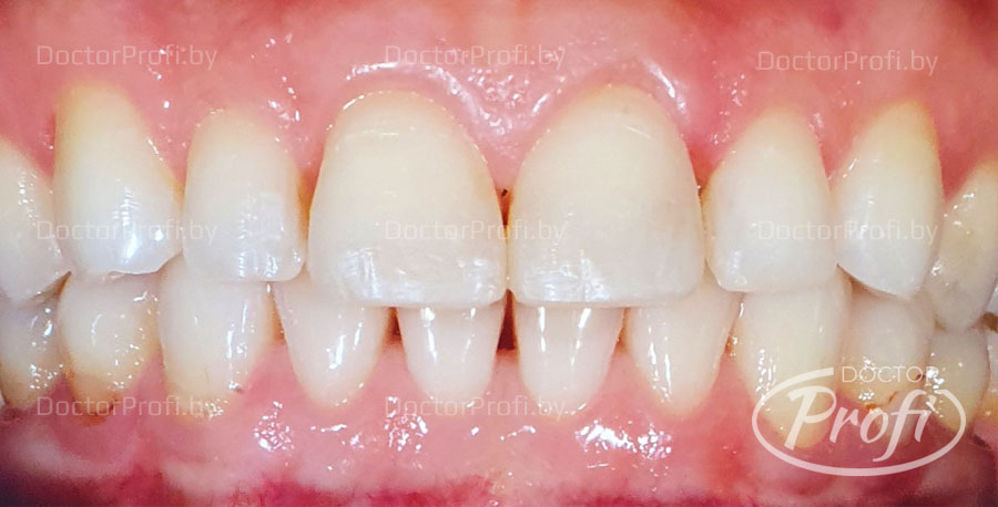 Устранение диастемы между передними зубами