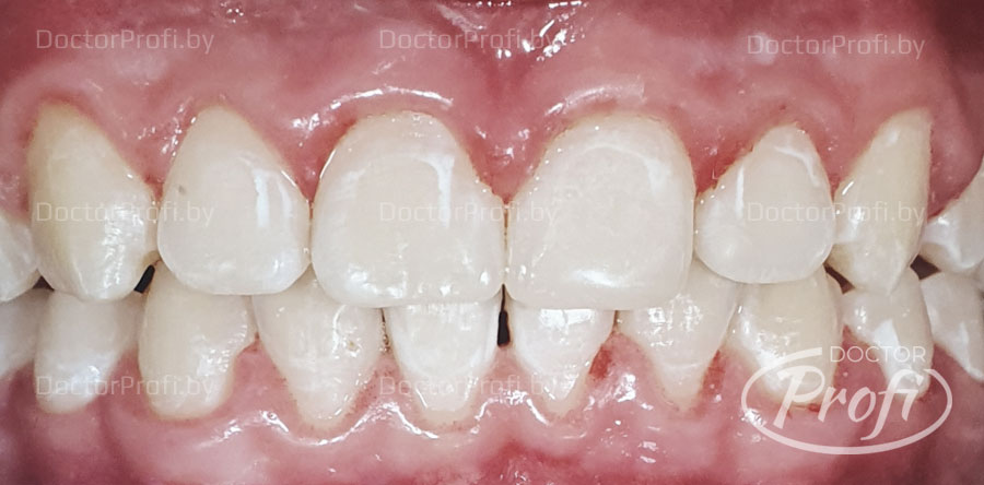 Ортодонтическое лечение брекет-системой Damon Q