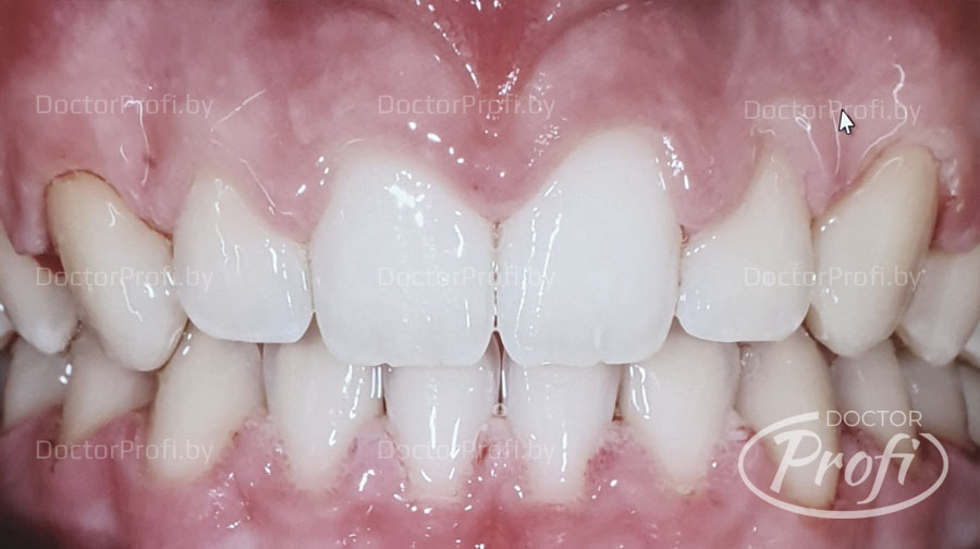 Устранение промежутков между зубами