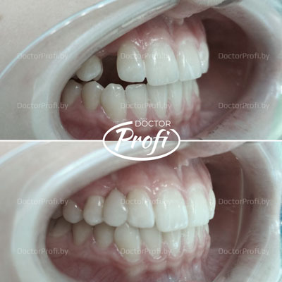 Адентия клыка. Восстановление отсутствующего зуба