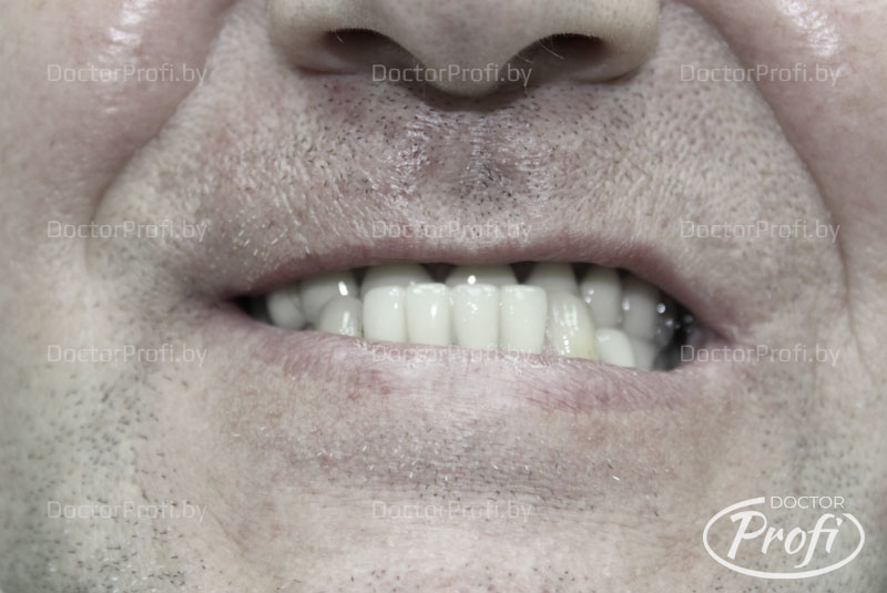 Полное протезирование зубов на 6 имплантатах фирмы MegaGen 
