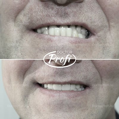 Полное протезирование зубов на 6 имплантатах фирмы MegaGen