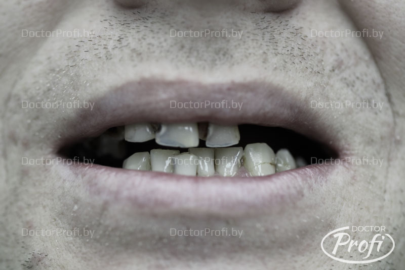Полное протезирование зубов верхней и нижней челюсти
