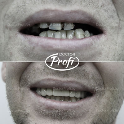 Полное протезирование зубов верхней и нижней челюсти