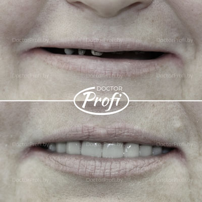 Полное протезирование зубов верхней челюсти