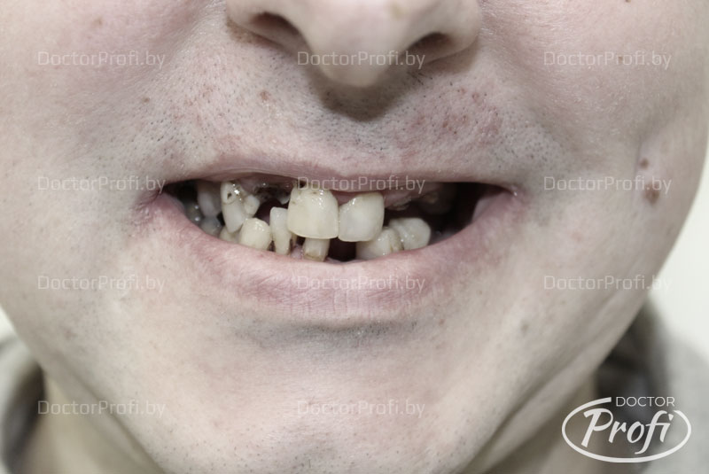 Восстановление зубов верхней и нижней челюсти
