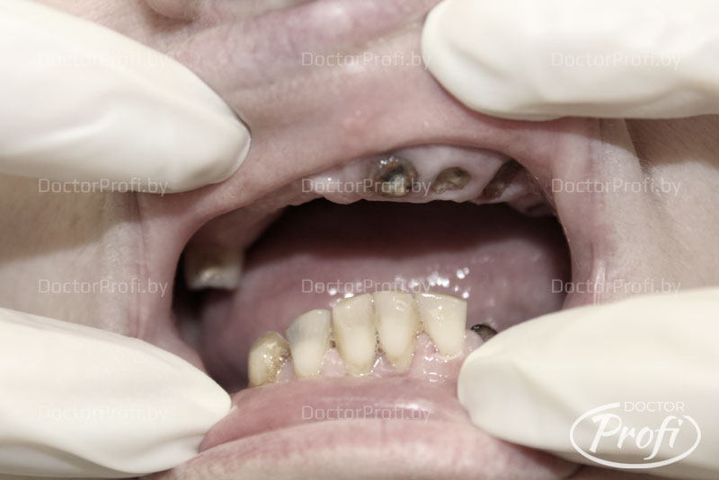 Полное протезирование зубов верхней челюсти 