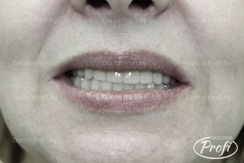 Полное протезирование зубов верхней челюсти 
