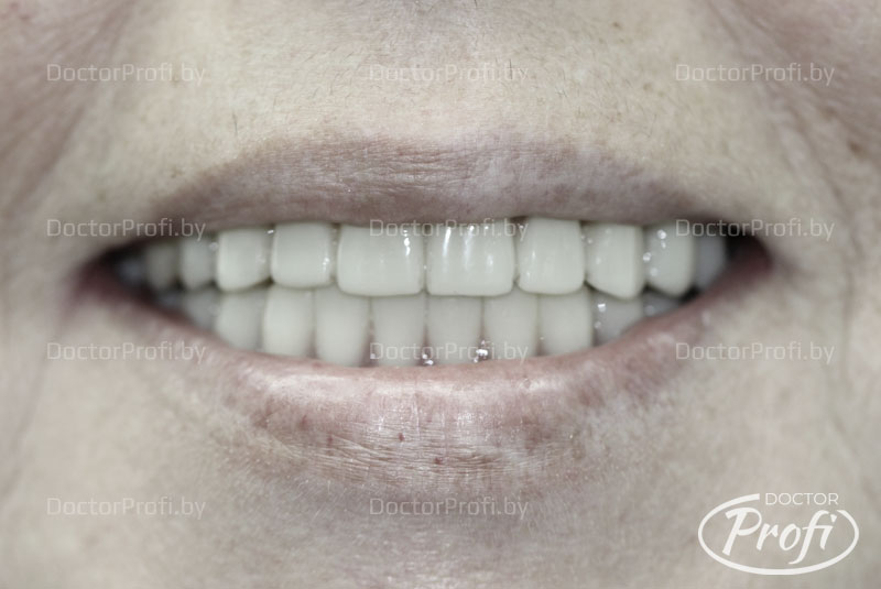 Одномоментная имплантация и протезирование всех зубов