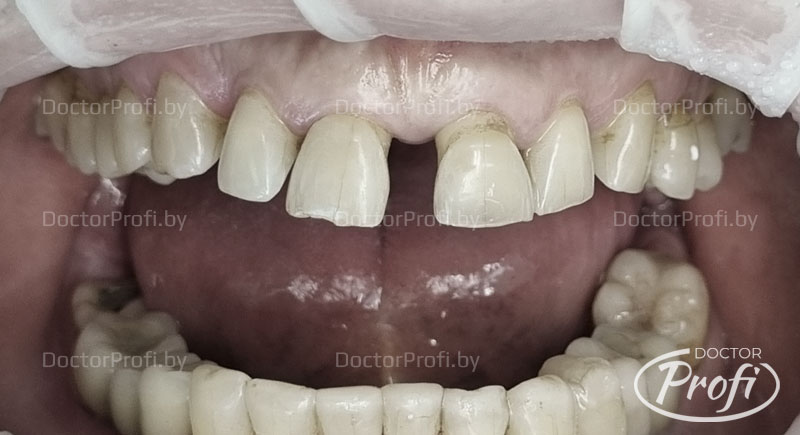 Виниринговое покрытие шести передних зубов