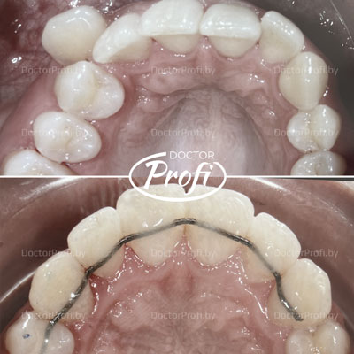 Исправление эстетического дефекта в зубном ряду
