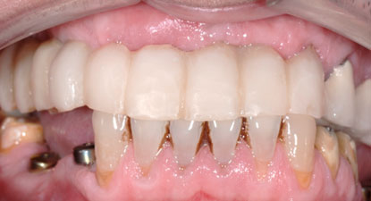Двухэтапная имплантация 10 зубов