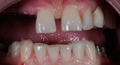 Полная реабилитация пациента с частичным отсутствием зубов 