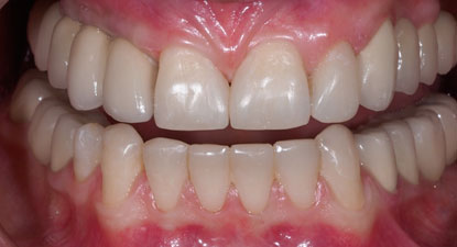 Полная реабилитация пациента с частичным отсутствием зубов 