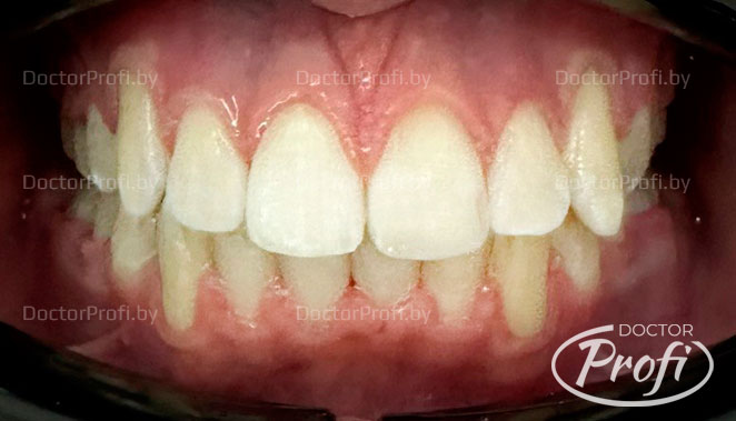 Ортодонтическое лечение металлическими брекетами Damon Q
