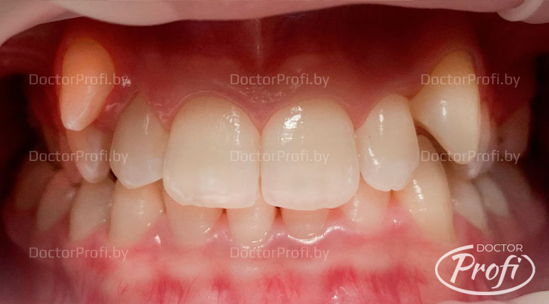 Ортодонтическое лечение брекетами Damon Q (Даймон Кью)