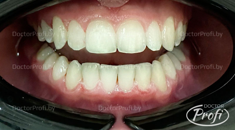 Ортодонтическое лечение брекетами Damon Q (Даймон Кью)