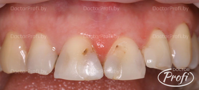 Реставрация 4-x передних зубов