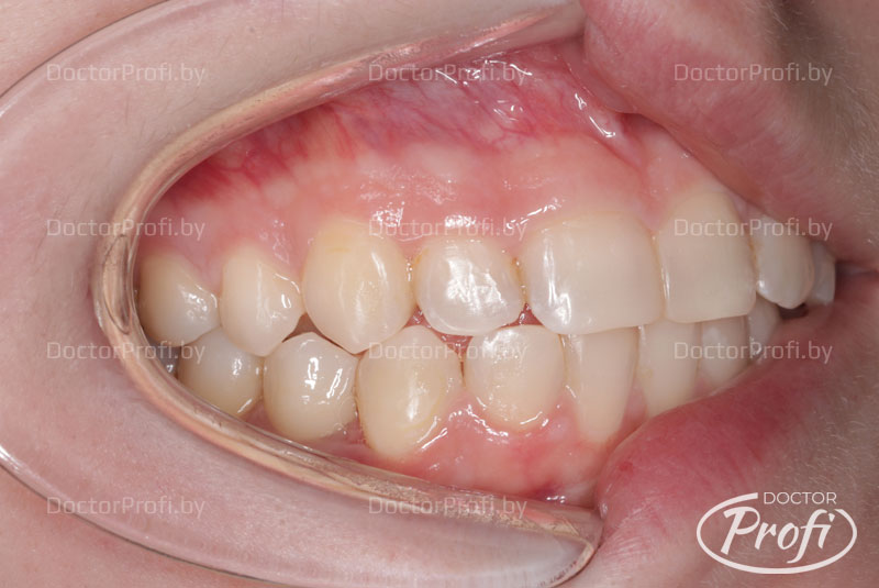 Установка имплантата Megagen AnyOne в области зуба 44