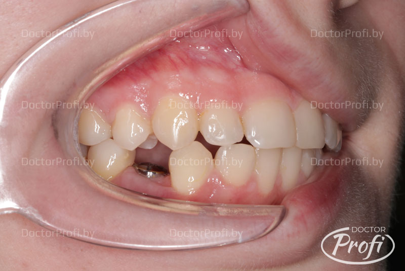 Установка имплантата Megagen AnyOne в области зуба 44