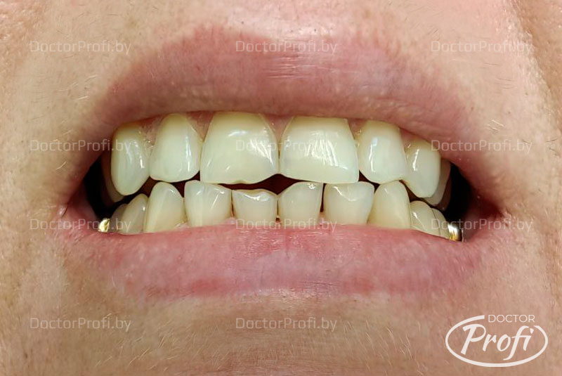 Коррекция формы зубов пломбировочным материалом