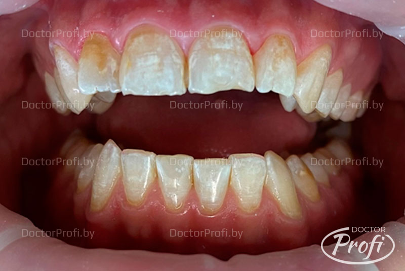 Устранение дефекта твердых тканей и неоднородности цвета фронтальных зубов