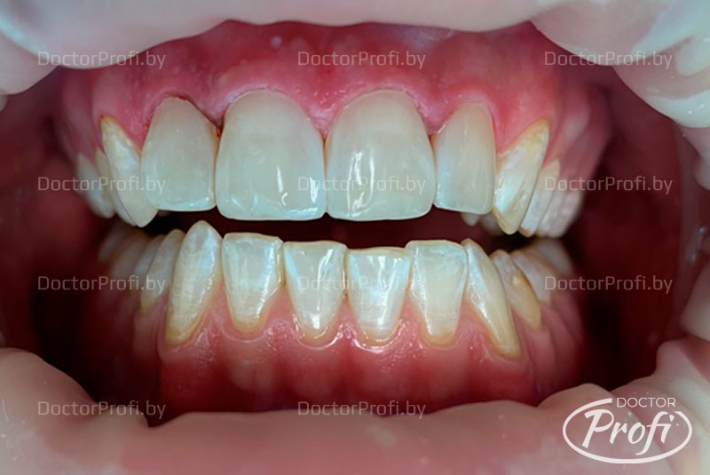Устранение дефекта твердых тканей и неоднородности цвета фронтальных зубов