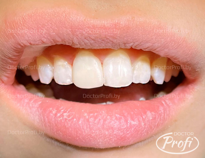Восстановление зуба после травмы