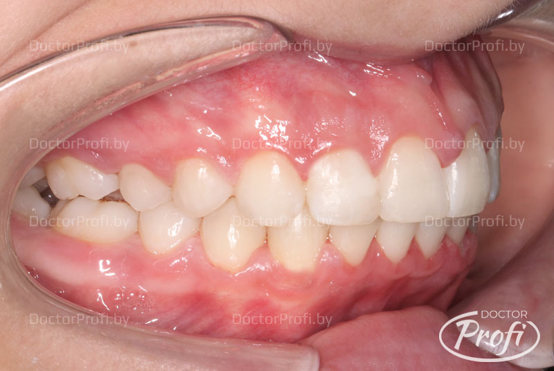 Исправление прикуса брекетами и реставрация передних зубов 