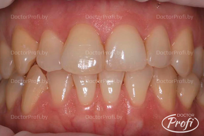 Осветление зубов с помощью профессионального отбеливания 