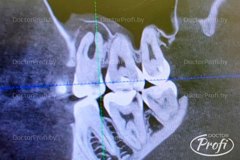 Перелечивание корневых каналов зуба 1.6