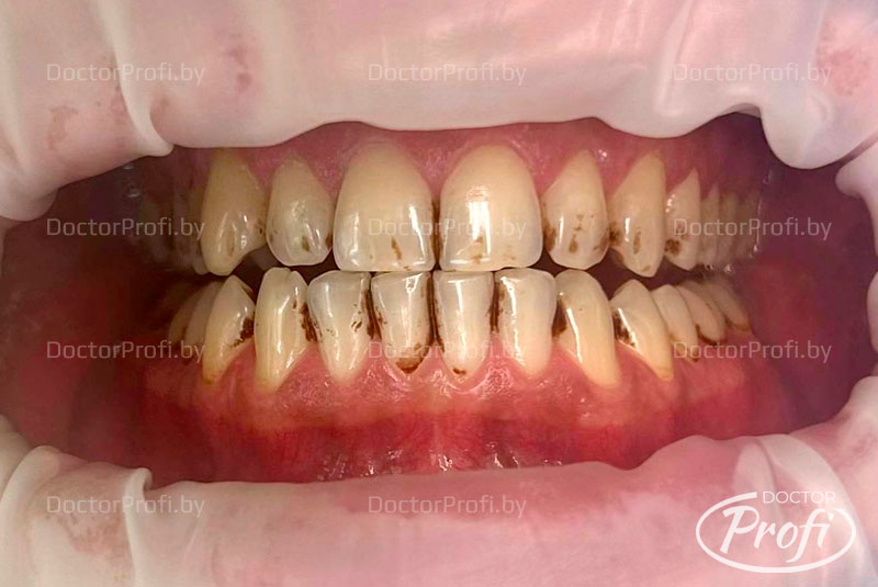 Профессиональная гигиена и фотоотбеливание зубов