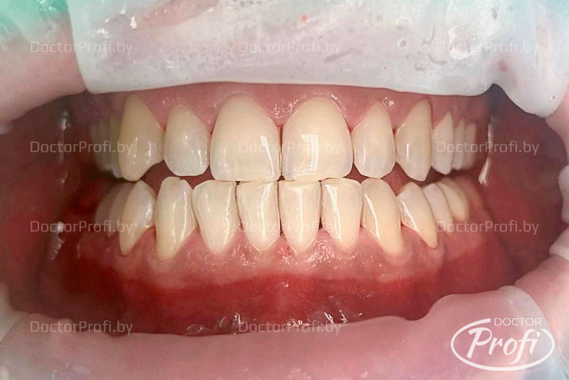 Профессиональная гигиена и фотоотбеливание зубов