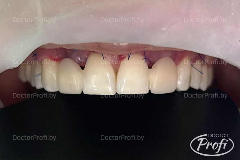 Реставрация предних зубов 