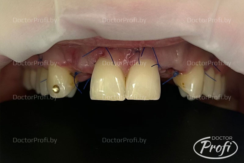 Реставрация предних зубов 