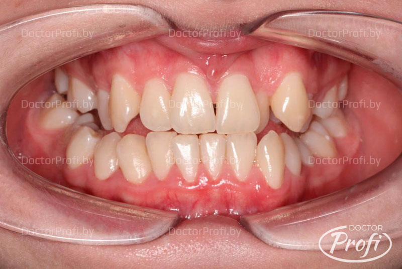 Исправление неправильного прикуса брекетами Damon Q