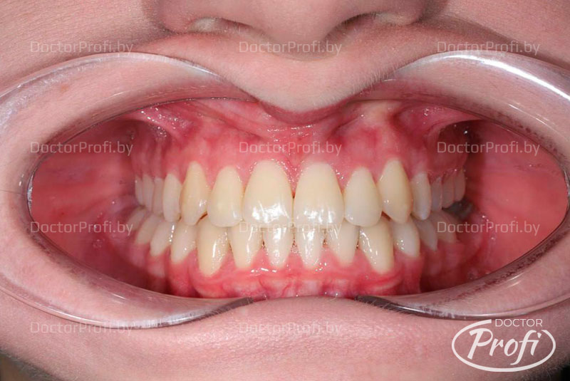 Исправление неправильного прикуса брекетами Damon Q